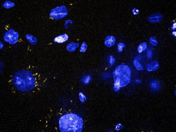   THP1 cells (DAPI stained) and THP1 cells infected with MCherry Mtb